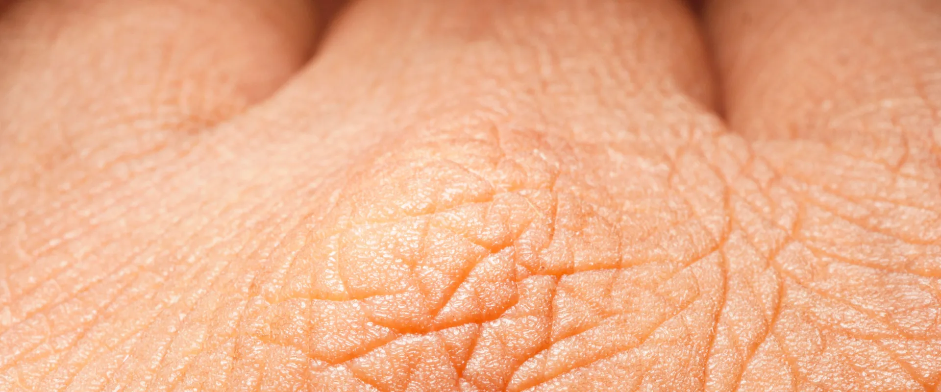 pergamenthaut ursachen tipps pflege