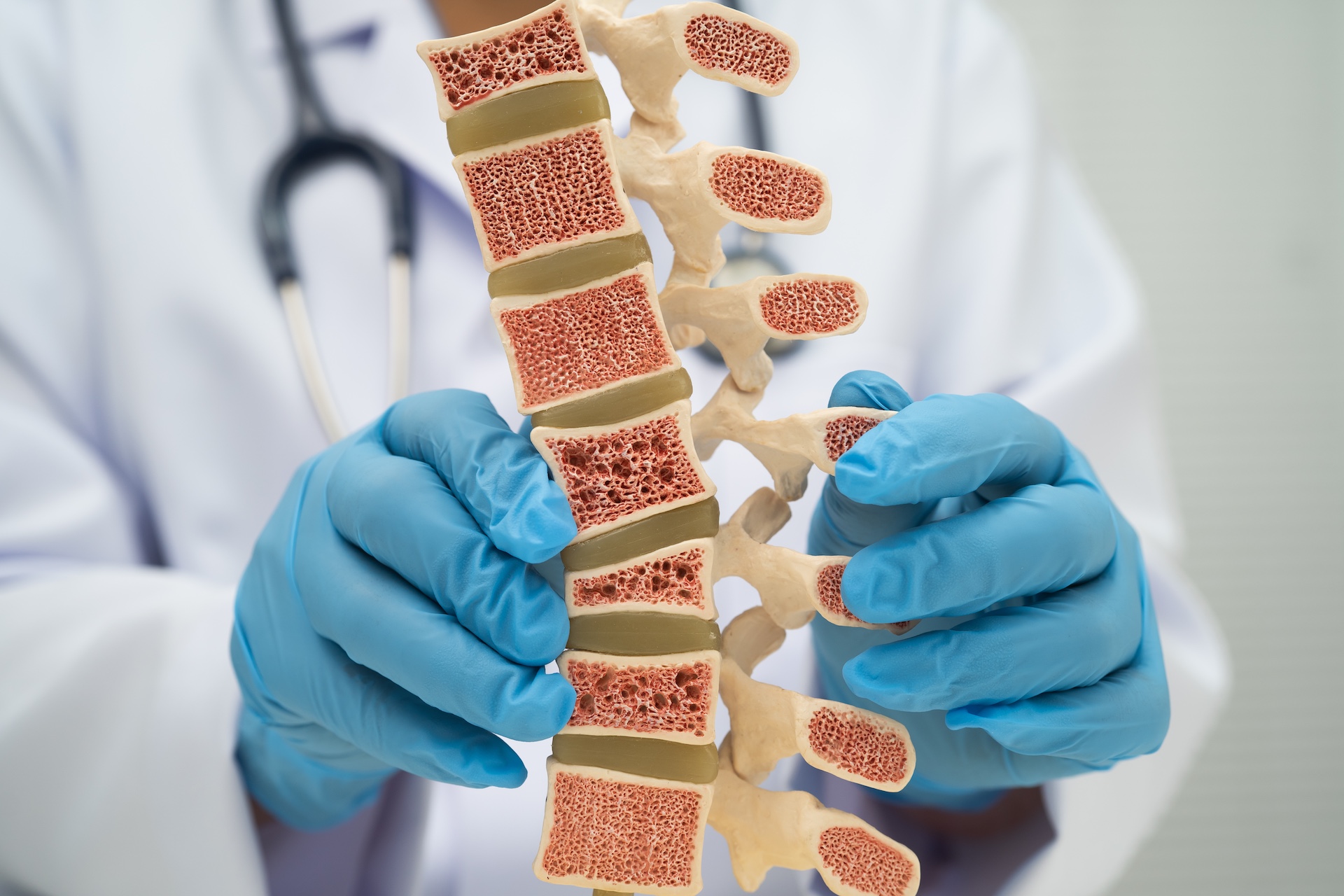 A doctor holding a model of the spine showing osteoporosis.