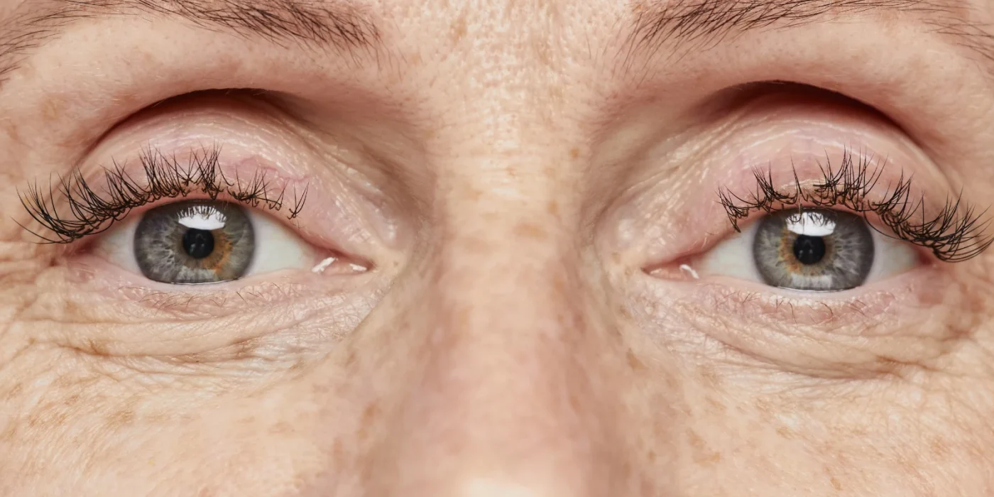 age spots