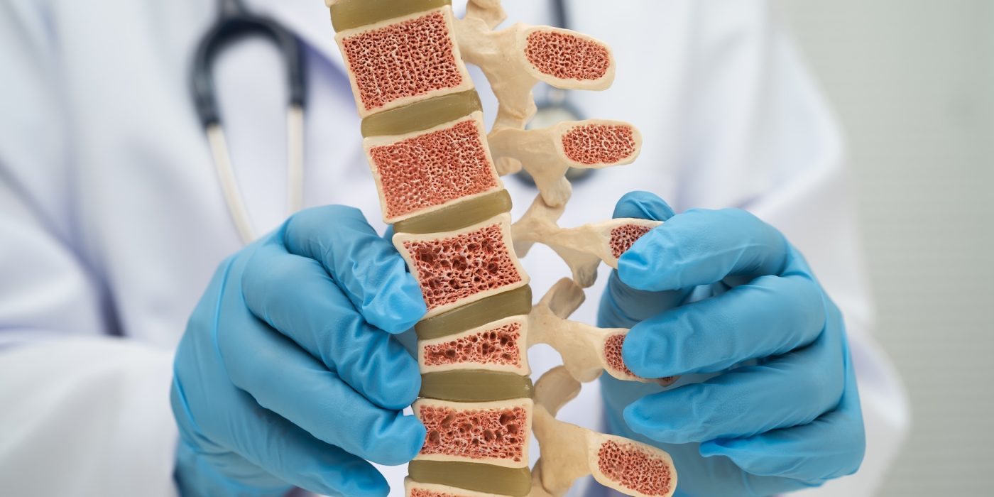doctor holding osteoporosis in back bone model.