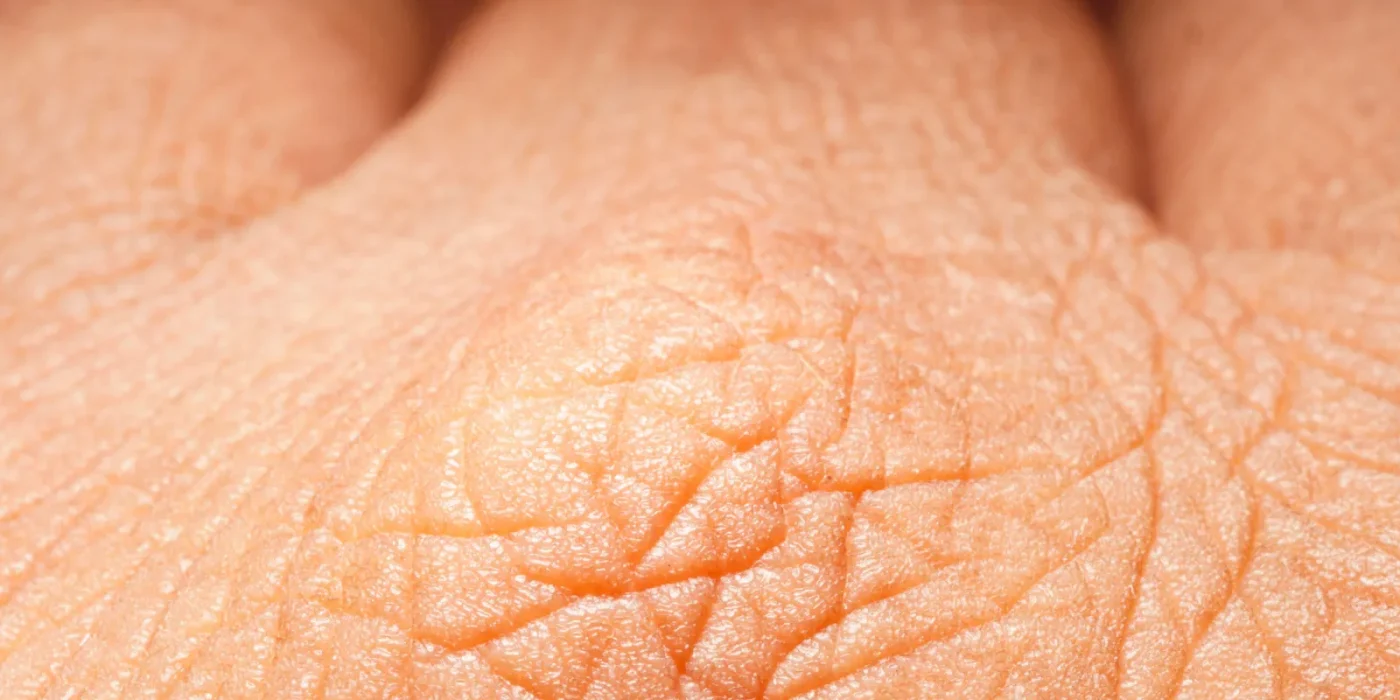 pergamenthaut ursachen tipps pflege